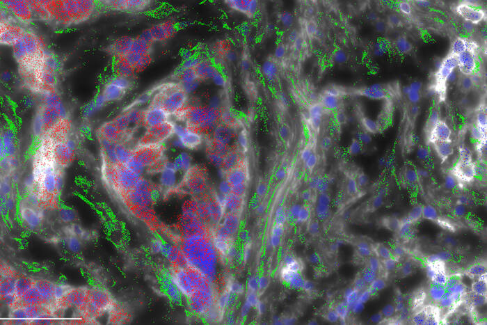 A deep view of FLC tumor tissue in blue, red, and green