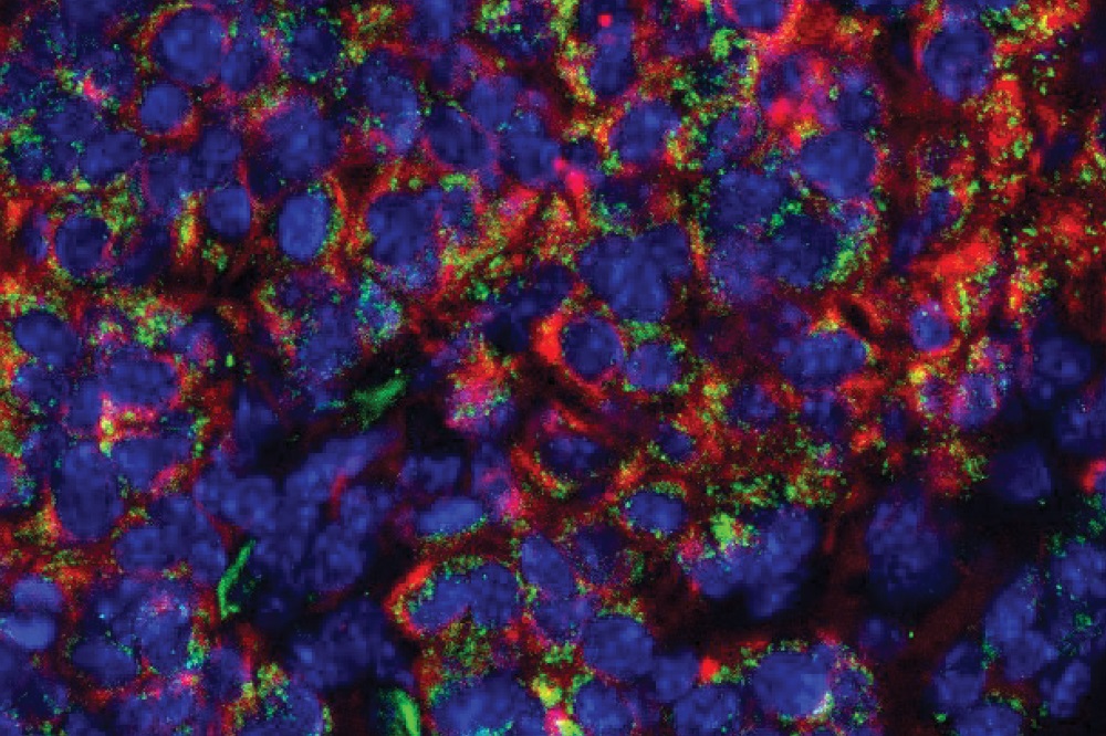 Figure 4f showing heightened expression of IFNGR1 (green) in mouse tumors where glycosphingolipid synthesis is blocked by knockout of SPTLC1. Nuclei are in blue and keratin (demarking cell borders) in red.