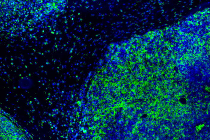 An immunofluorescence IHC image of T cells in green attacking tumor cells in blue on a black background