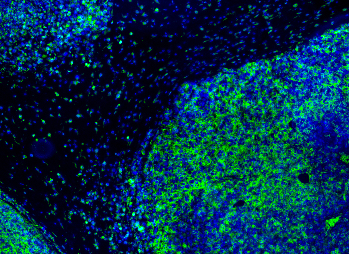 An immunofluorescence IHC image of T cells in green attacking tumor cells in blue on a black background 