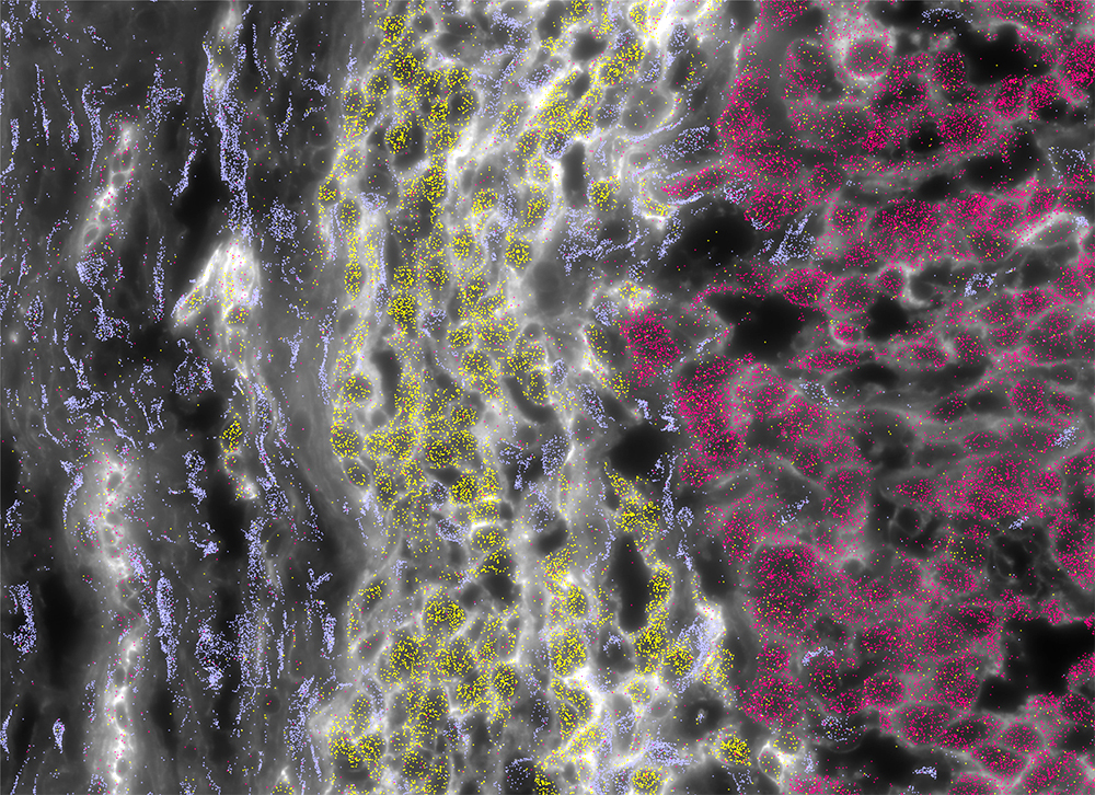 Histological section of an FLC tumor