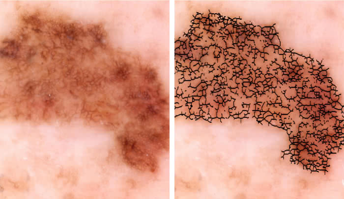 The Rockefeller University Researchers Develop Automated Melanoma 